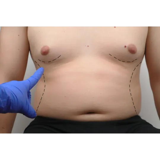 breast_surgery